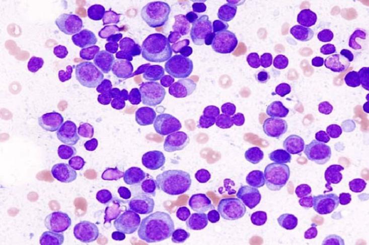 Multiple Myeloma merupakan salah satu jenis kanker darah yang menyerang sel plasma di sumsum tulang belakang. Foto: Ilustrasi/Ist