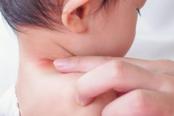 Diperkirakan 15 sampai 20 persen anak-anak menderita Dermatitis Atopik atau eksim. Foto: Ist