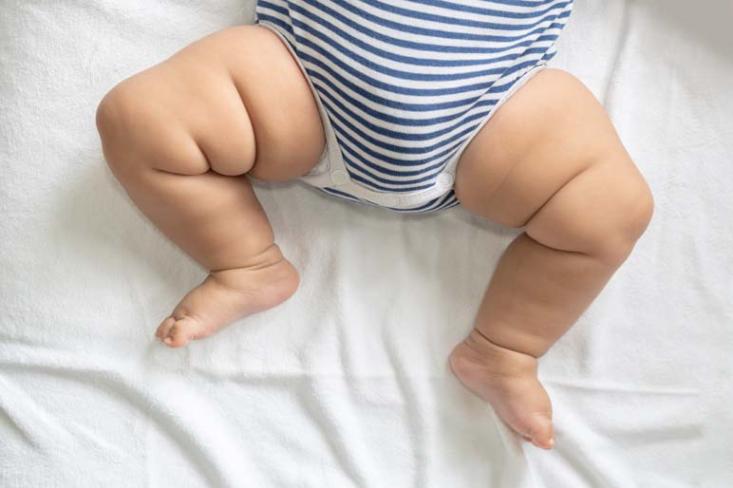 Menurut data 62,5 persen bayi mengalami iritasi area popok di tahun pertama kehidupannya, mulai dari kemerahan ringan hingga iritasi yang dapat mengganggu kenyamanan bayi (Foto : Freepik)