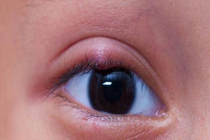 Penggunaan produk makeup mata yang sudah kedaluwarsa atau tidak dibersihkan dengan baik juga dapat menjadi media berkembangnya bakteri. Foto: Ist